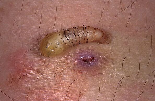 potkožna larva parazit čovjeka